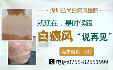 深圳白癜风医院哪家好介绍儿童白斑的辅助治疗有哪些